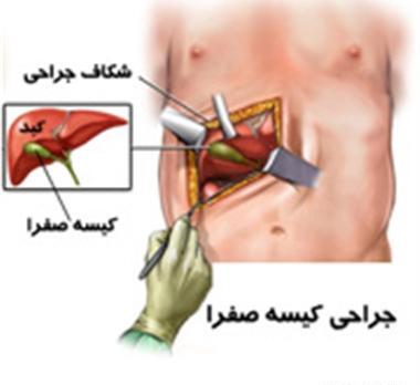 عکس سنگ صفرا در بدن