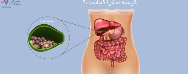 عکس سنگ صفرا در بدن