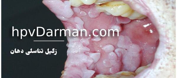 عکس ویروس پاپیلوما