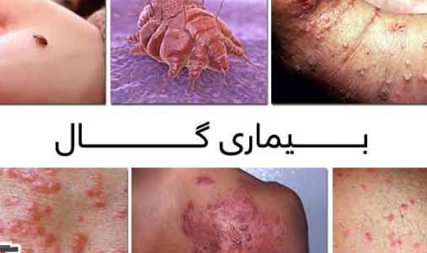 عکس پشه گال