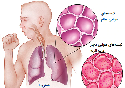عکس ریه در کجای بدن قرار دارد