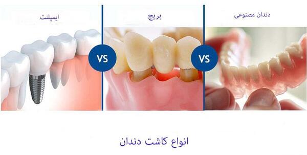 عکس کاشت دندان یا ایمپلنت
