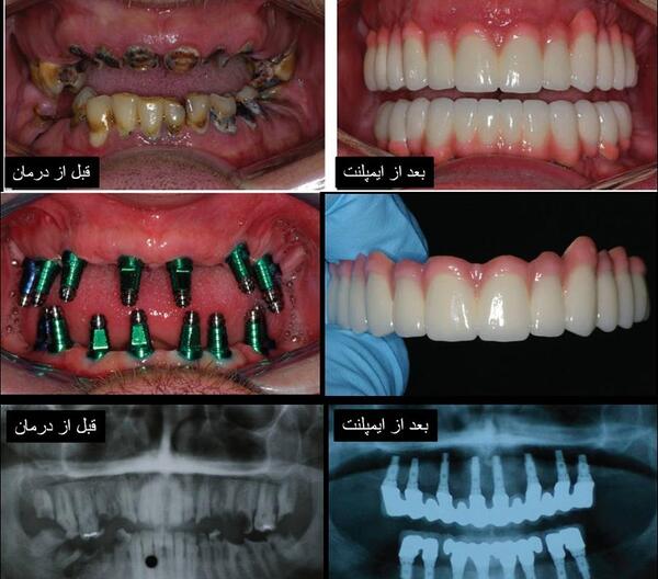 عکس کاشت دندان یا ایمپلنت