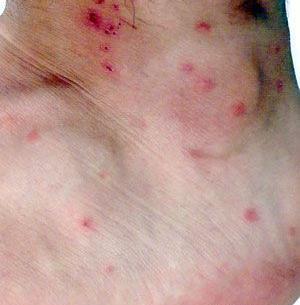عکس کنه گزیدگی