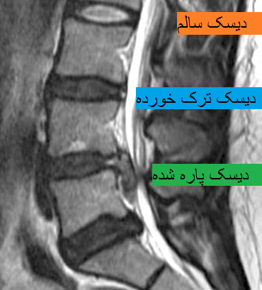 نمونه عکس ام ار ای کمر سالم