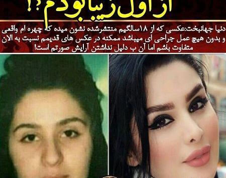 عکس اشکان اشتیاق قبل از عمل بینی
