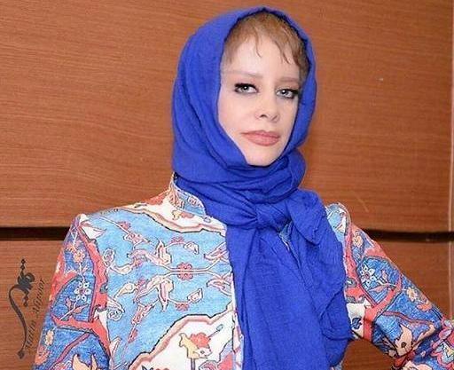 عکس شراره رخام قبل و بعد از تزریق ژل