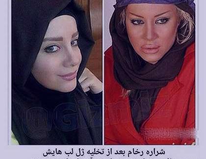عکس شراره رخام قبل و بعد از تزریق ژل