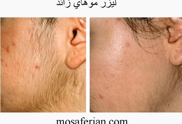 عکس لیزر موی زائد