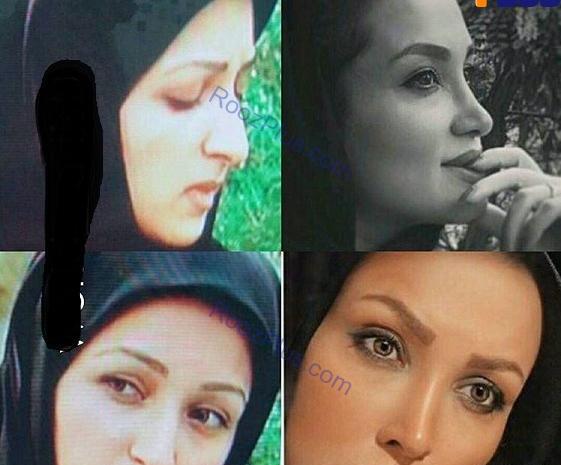 عکس حدیث میرامینی قبل از عمل