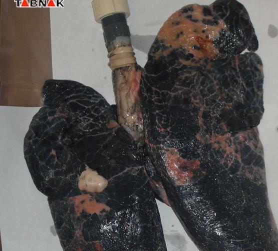 عکس ریه ی سیگاری