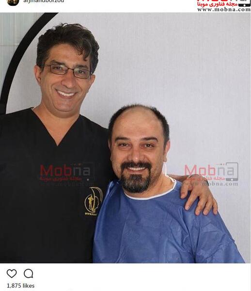 عکس برزو ارجمند بعد از کاشت مو