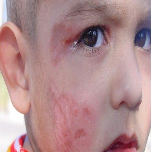 عکس پشه ناقل سالک