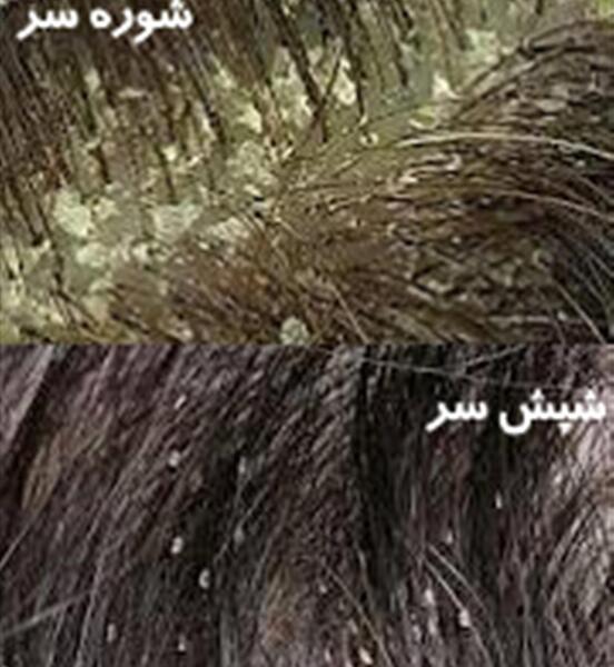 عکس شپش توی موی سر