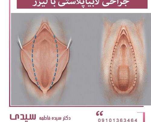 عکس های واقعی عمل لابیاپلاستی