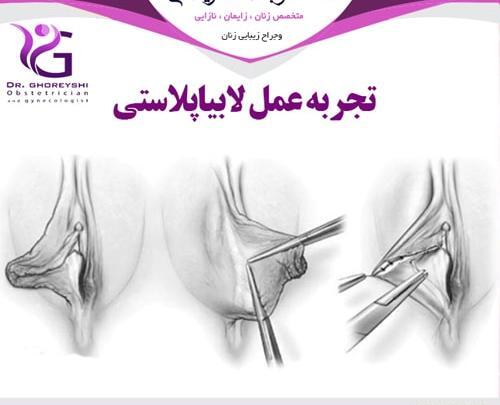 عکس های واقعی عمل لابیاپلاستی