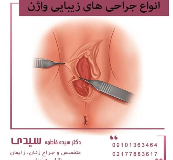 عکس های واقعی عمل لابیاپلاستی