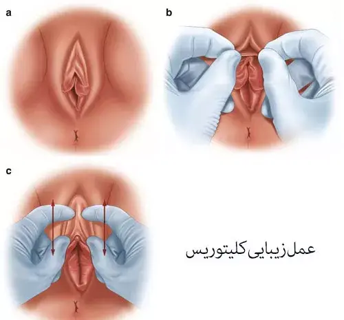عکس های واقعی عمل لابیاپلاستی