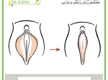 عکس های واقعی عمل لابیاپلاستی