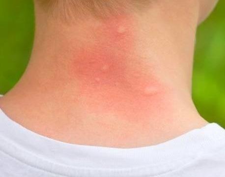 عکس نیش سوسک