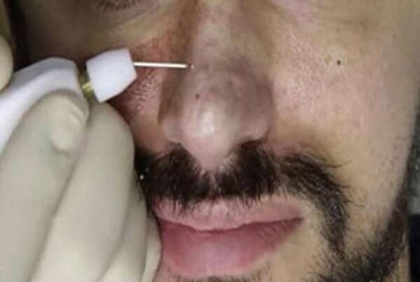 عکس وحشتناک عمل بینی