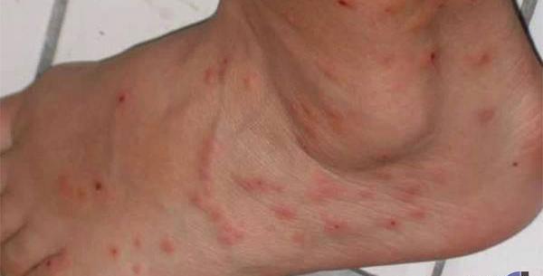 عکس کنه پرنده