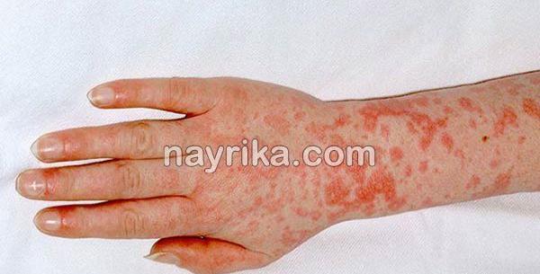 عکس ویروس مخملک