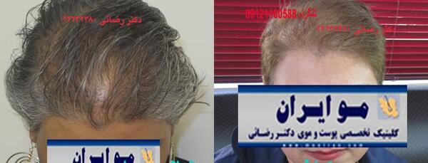 عکسهای کاشت موی زنان