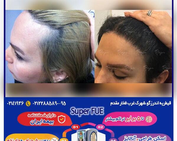 عکسهای کاشت موی زنان