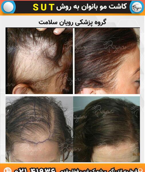 عکسهای کاشت موی زنان