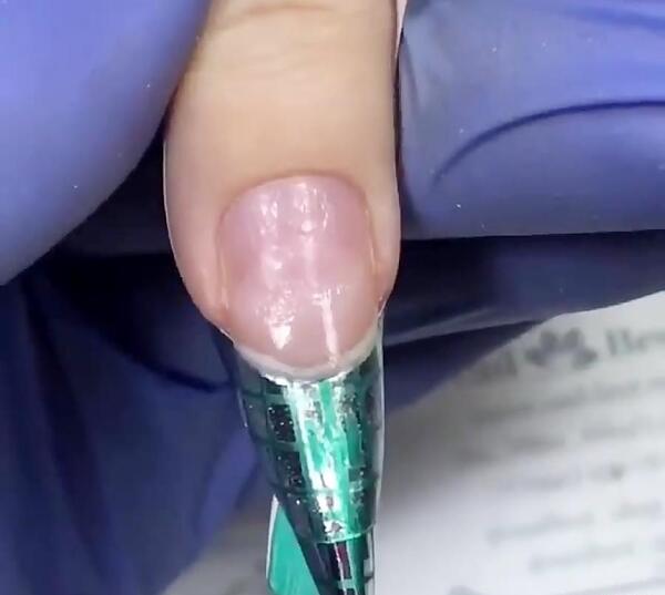 عکس کاشت با پلی ژل