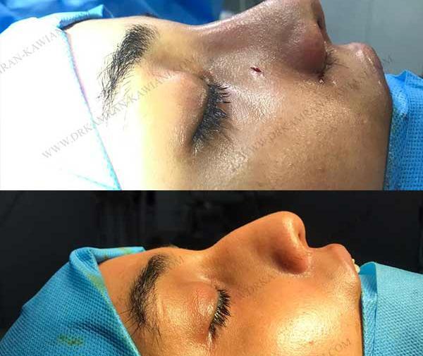عکس در حال جراحی بینی