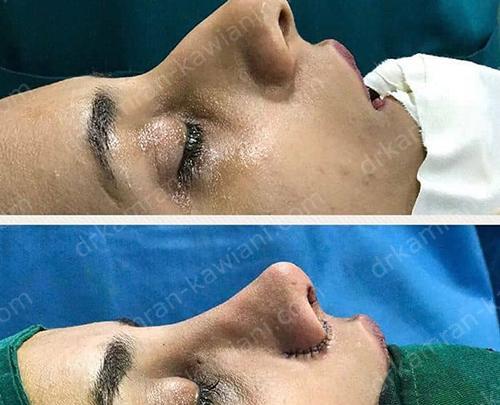 عکس در حال جراحی بینی