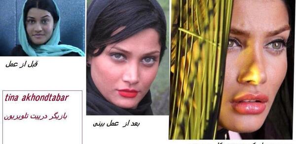 عکس آنا نعمتی قبل و بعد عمل