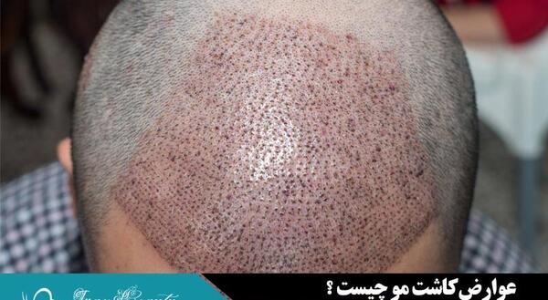 عکس عوارض کاشت مو