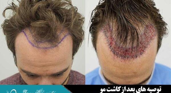 عکس عوارض کاشت مو