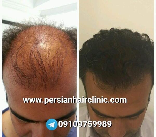 عکس عوارض کاشت مو