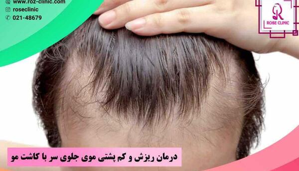 عکس عوارض کاشت مو