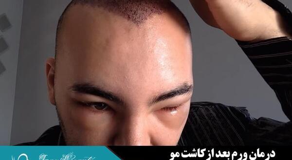 عکس عوارض کاشت مو