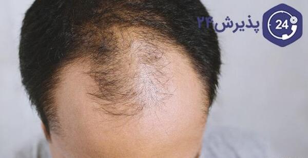عکس عوارض کاشت مو