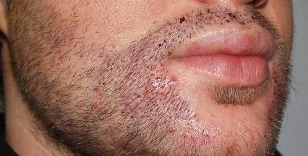 عکس ریش صورتی