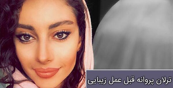 عکس ترلان پروانه قبل از عمل دماغ