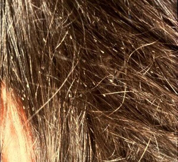 عکس علائم شپش