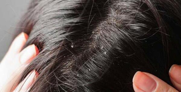 عکس شپش سر در کودکان