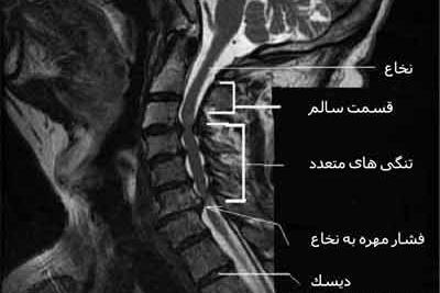 عکس ام ار ای تنگی کانال نخاع