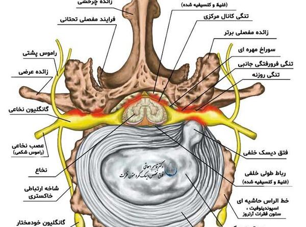 عکس ام ار ای تنگی کانال نخاع