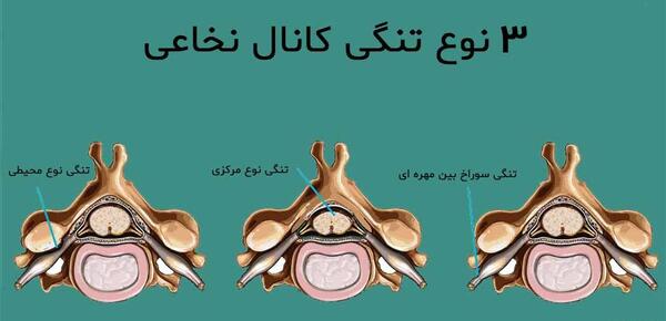 عکس ام ار ای تنگی کانال نخاع