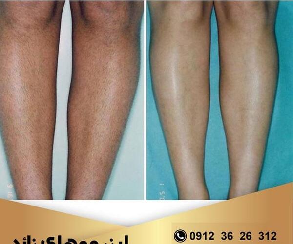 عکس های لیزر مو