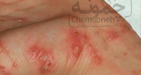 عکس ویروس گال