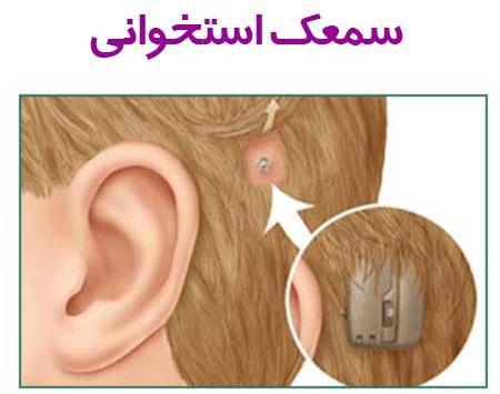 عکس کاشت حلزون نامرئی